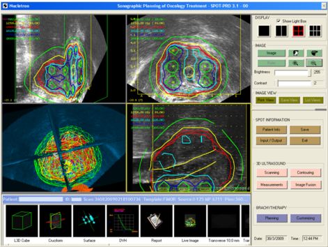 Distribuci&oacute;n dosis IMRT pr&oacute;stata