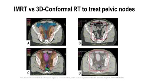 IMRT vs RT 3D Conformada para tratar los ganglios p&eacute;lvicos en c&aacute;ncer de pr&oacute;stata