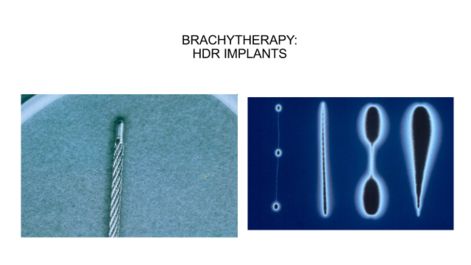 Braquiterapia de pr&oacute;stata: implantes hdr