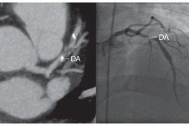  ANGIO TAC CORONARIA: Un avance en el diagn&oacute;stico cardiol&oacute;gico  | BCM