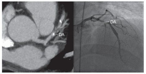  ANGIO TAC CORONARIA: Un avance en el diagn&oacute;stico cardiol&oacute;gico 