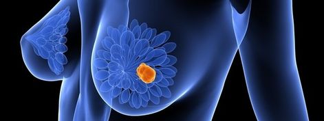Immune cells and breast cancer