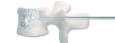 Vertebroplastia, soluci&oacute;n al dolor de espalda 