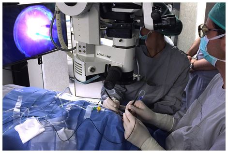 Cirug&iacute;a de V&iacute;treo con tecnolog&iacute;a 3D