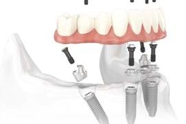 IMPLANTOLOG&Iacute;A- ALL-ON4