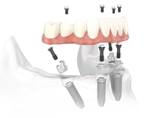 IMPLANTOLOG&Iacute;A- ALL-ON4